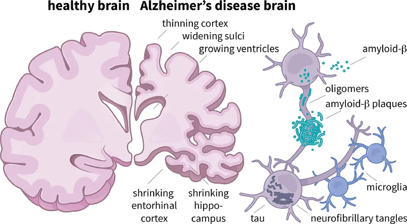 Alzheimer’s Brain Changes: Gross and Microscopic