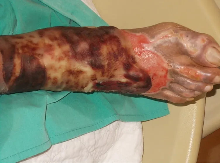 Skin lesions and necrosis in leprosy neuropathy