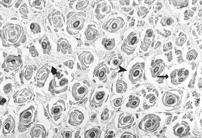Onion bulb formation in Charcot-Marie-Tooth disease