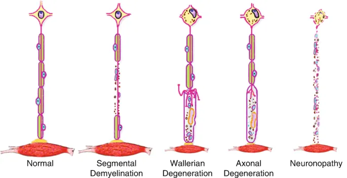 Peripheral nerve degeneration types