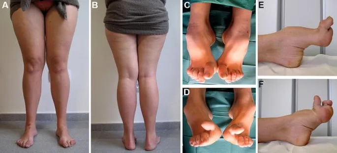Charcot-Marie-Tooth: Pes Cavus and Stork Leg Deformity
