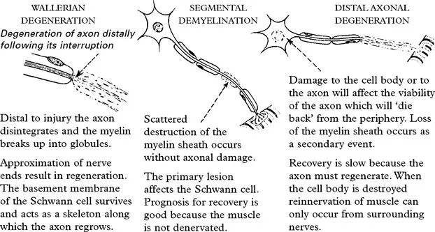 Axonal degeneration vs. segmental demyelination