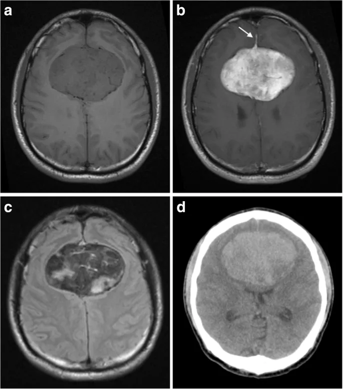 MRI and CT of extra-axial meningioma with dural tail