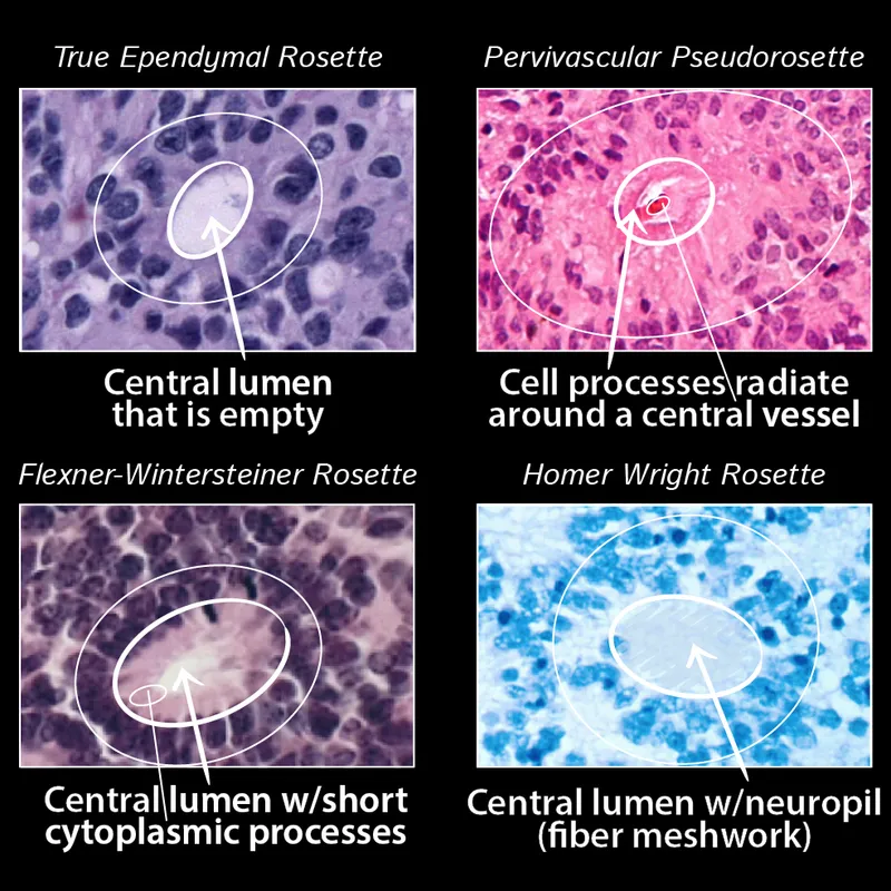 Histopathology of Rosettes in CNS Tumors