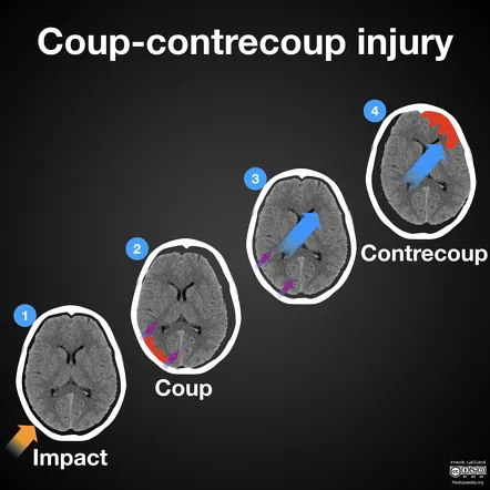 Coup-contrecoup injury mechanism diagram