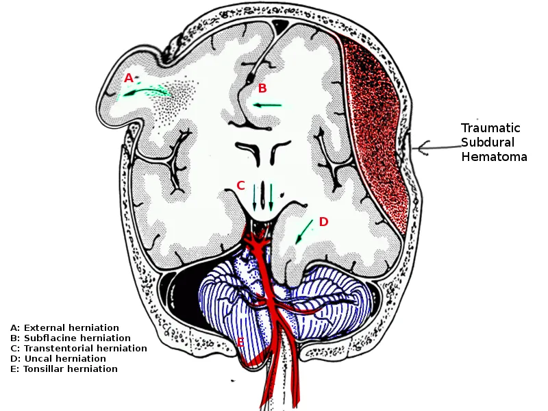 Brain herniation types in traumatic subdural hematoma