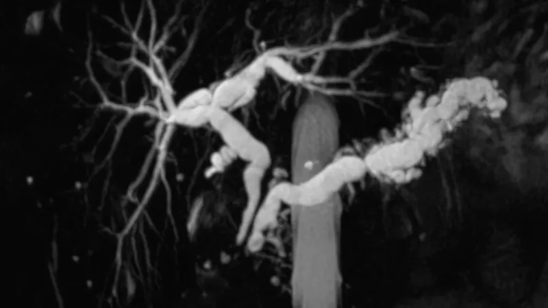 MRCP showing dilated pancreatic duct