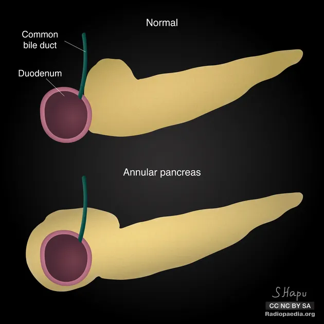 Annular pancreas vs normal anatomy