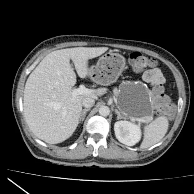Large pancreatic pseudocyst on CT scan