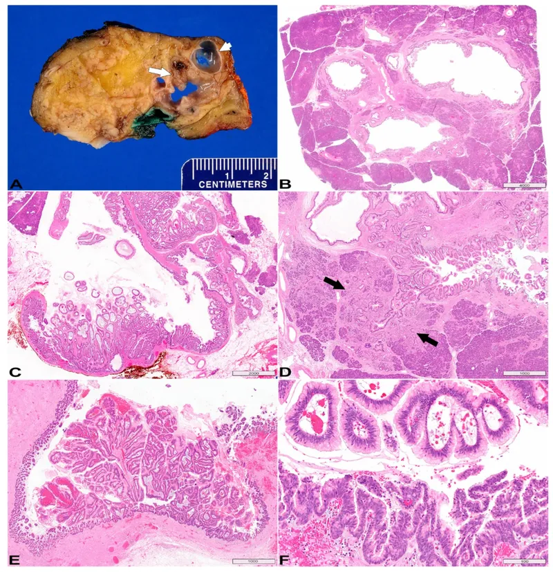 Histopathology of IPMN and MCN