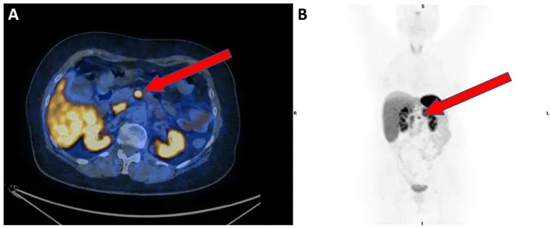 Ga-68 DOTATATE PET CT of PNET