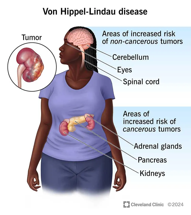 Von Hippel-Lindau disease tumor risk areas
