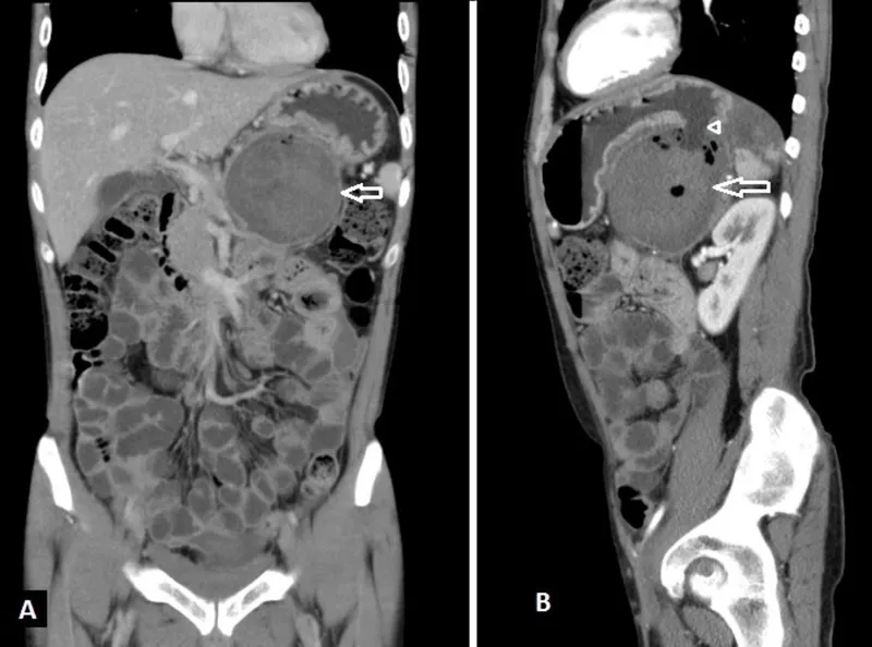 CECT abdomen showing large pancreatic pseudocyst