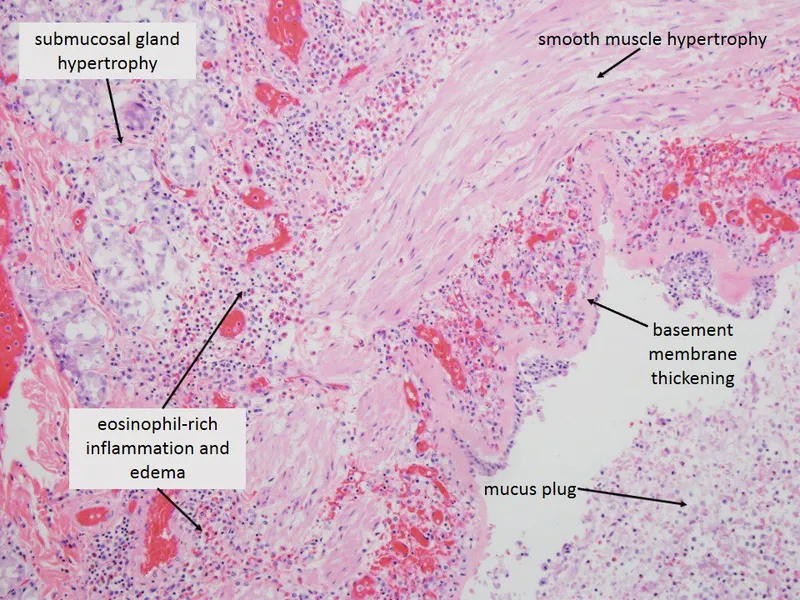 Asthma Bronchus Histology: Inflammation, Hypertrophy, Mucus
