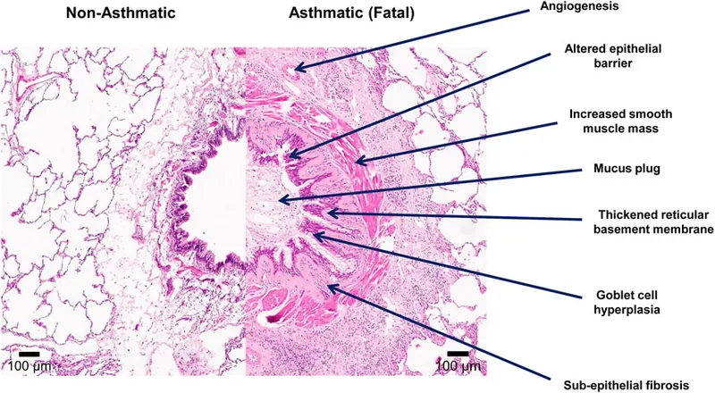 Asthmatic vs. Non-Asthmatic Bronchiole Histopathology