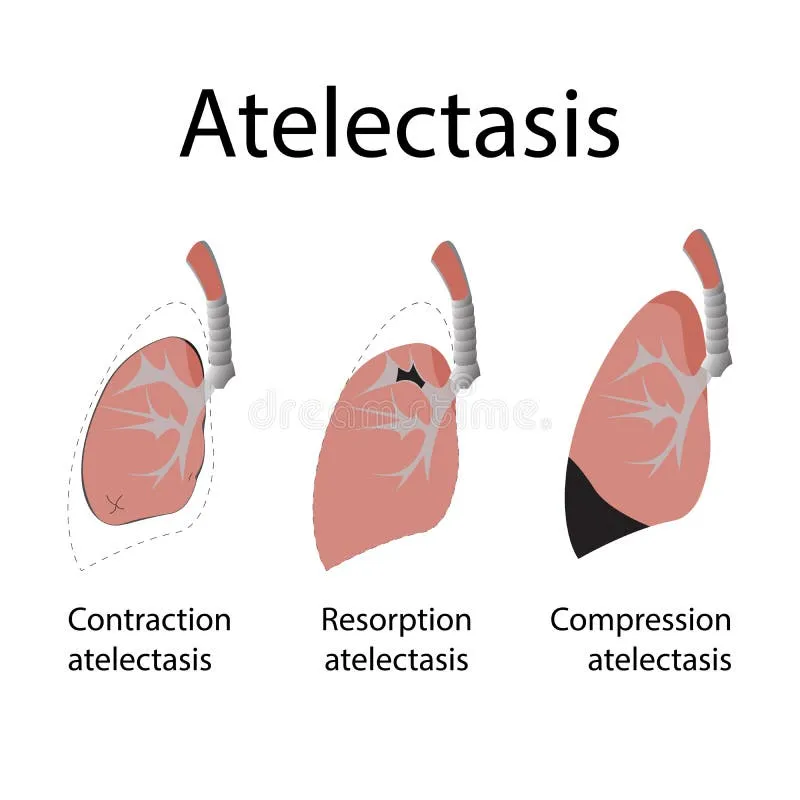 Types of Atelectasis: Contraction, Resorption, Compression