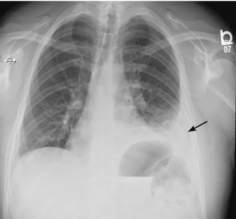 Chest X-ray: Left pleural effusion with fluid level