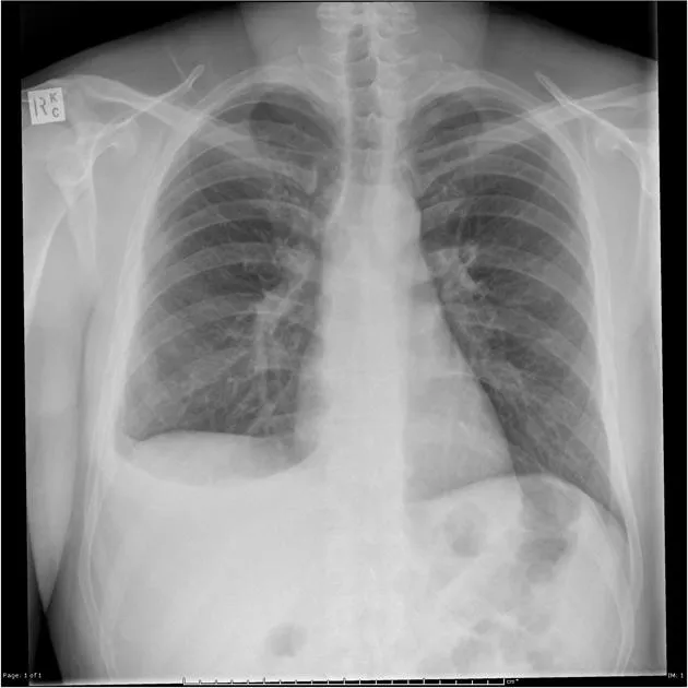 Chest X-ray: Right Pleural Effusion with Blunted Angle