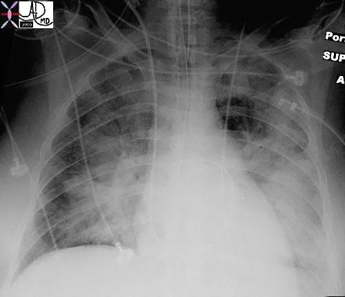 Chest X-ray: Pulmonary Edema with Batwing Appearance