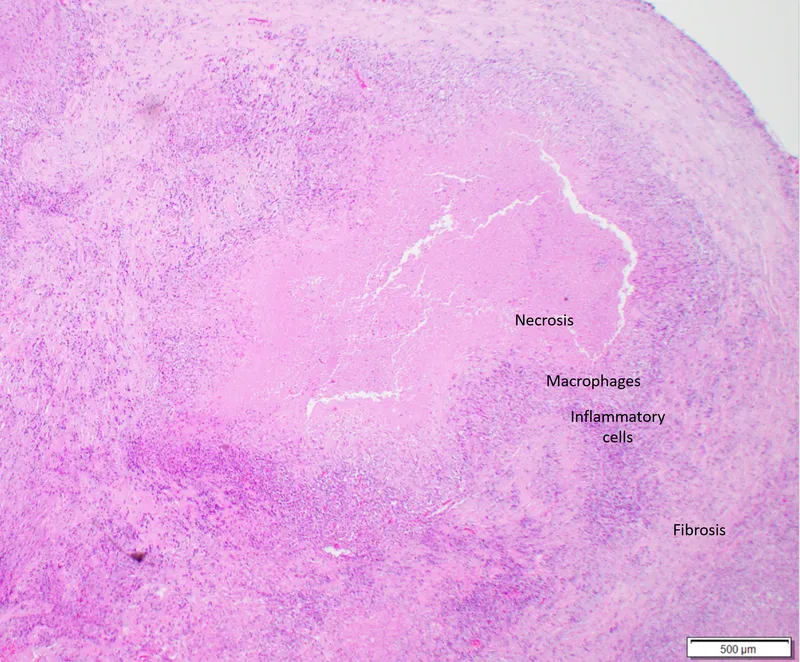 Histopathology of Caseating Granuloma in Tuberculosis