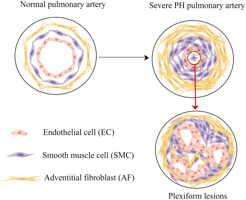 Plexiform lesions in severe pulmonary hypertension