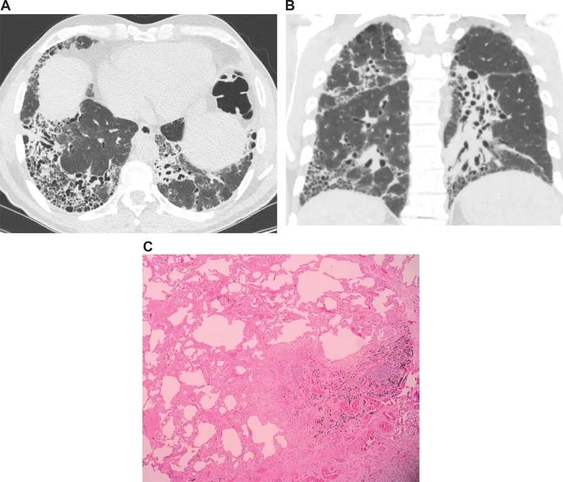 CT and histology of idiopathic pulmonary fibrosis