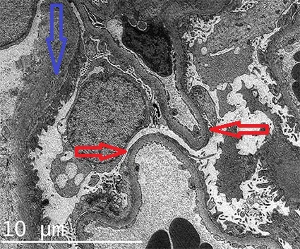 Electron microscopy of podocyte effacement