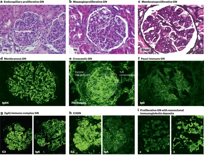 Histopathology of Glomerulonephritis