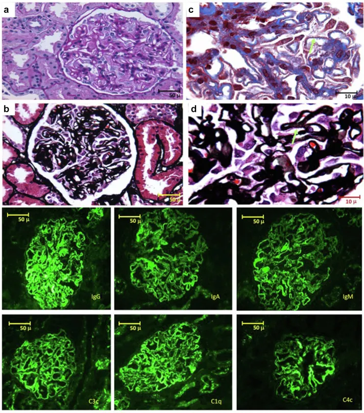 Lupus Nephritis Immunofluorescence "Full House" Pattern
