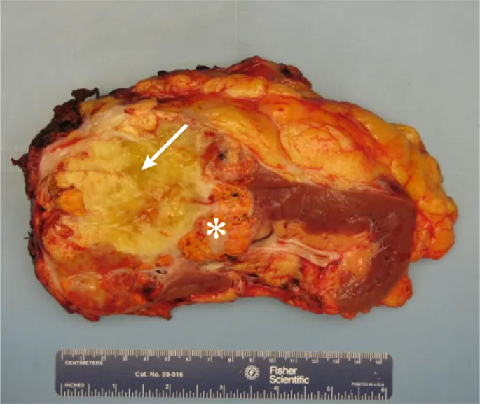 Renal Cell Carcinoma, gross cut section