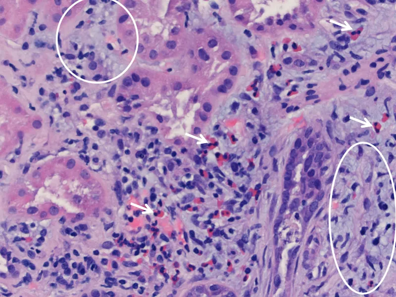 Acute interstitial nephritis with eosinophilic infiltrate