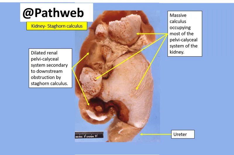 Kidney with staghorn calculus and dilated renal pelvis
