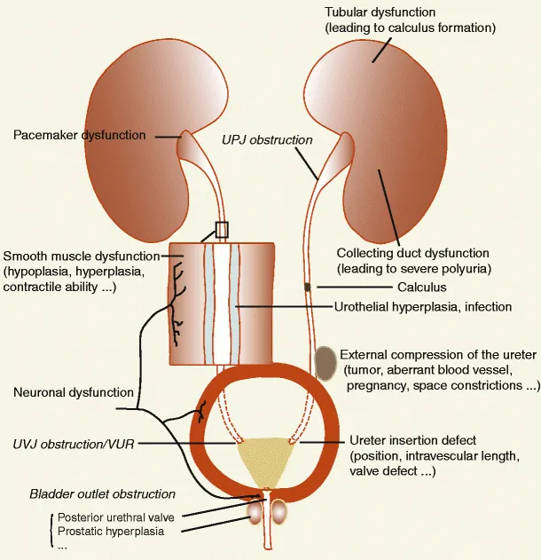Causes of urinary tract obstruction
