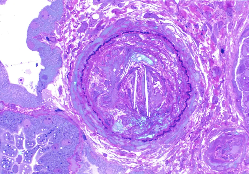 Cholesterol crystal clefts in renal arteriole