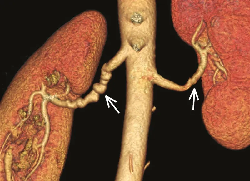 Renal artery fibromuscular dysplasia "string of beads"