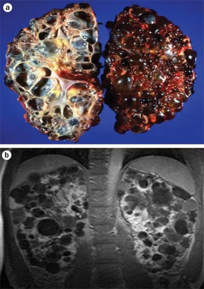 Gross and MRI of Adult Polycystic Kidney Disease
