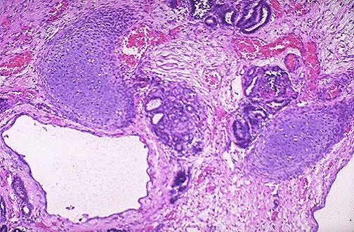 Multicystic dysplastic kidney: cartilage and primitive ducts
