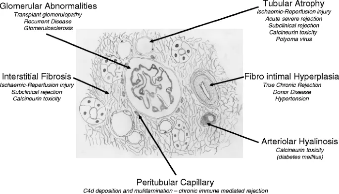 Kidney Transplant Pathology: Histological Features