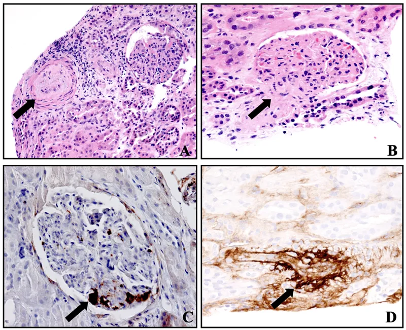 Kidney Transplant Rejection Histopathology