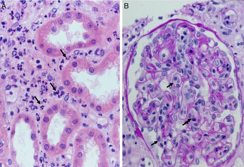 Acute kidney rejection: tubulitis and C4d deposition