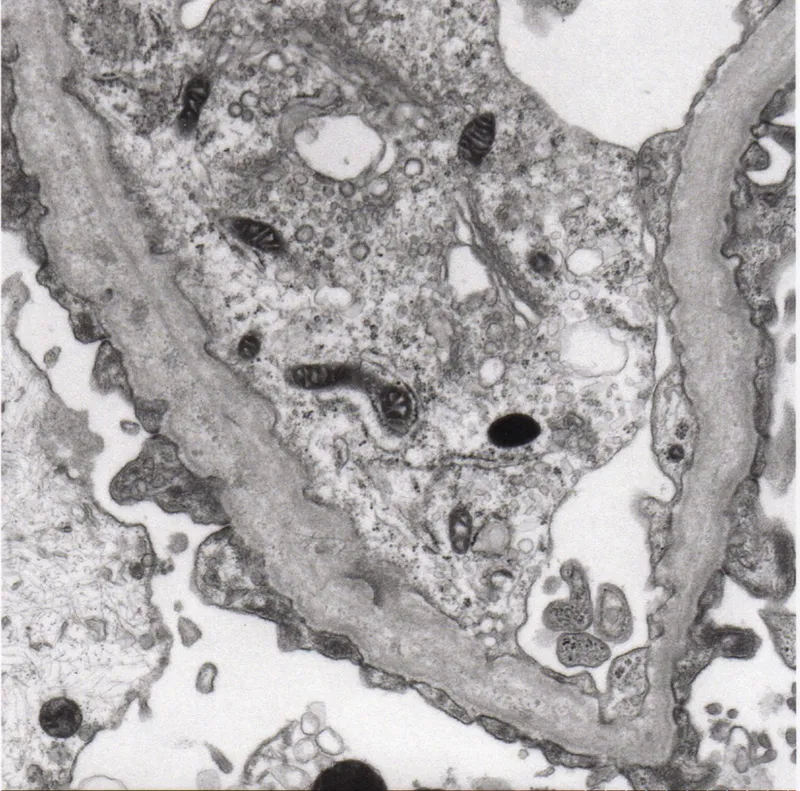 Alport Syndrome: EM of GBM basket-weave appearance