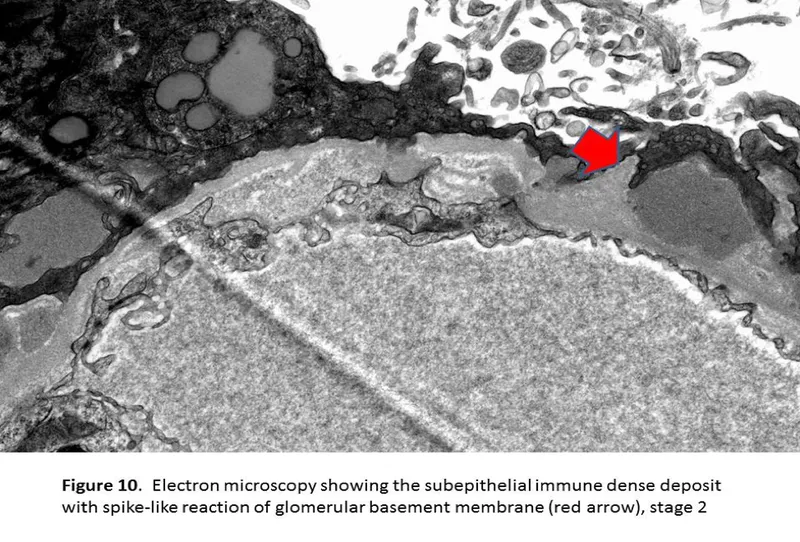Membranous Nephropathy: Subepithelial Deposits & Spikes