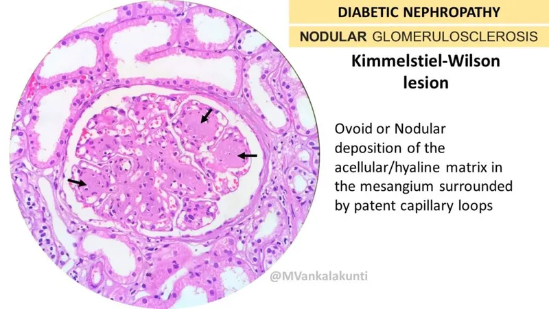 Diabetic Nephropathy: Kimmelstiel-Wilson Lesion