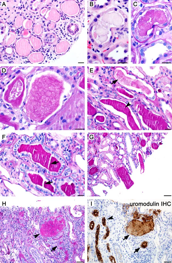 Histopathology of Pyelonephritis with Casts and Neutrophils