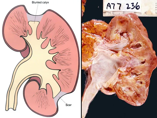 Chronic Pyelonephritis: Gross Pathology and Diagram