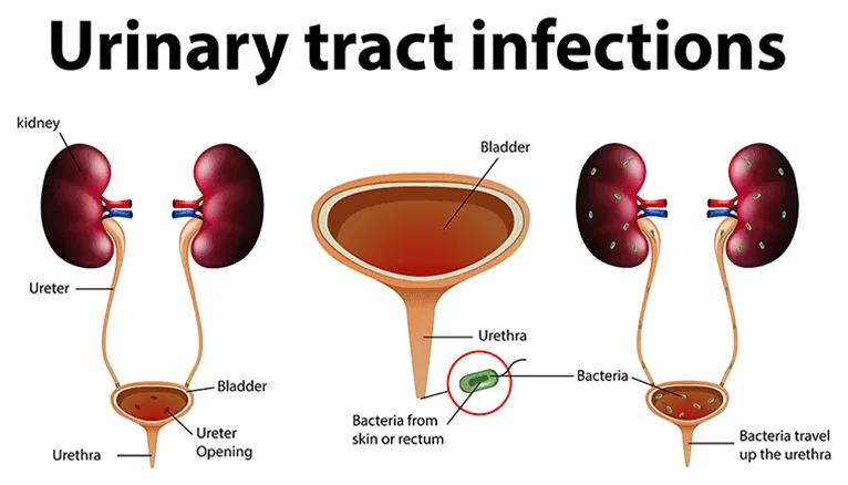 Urinary Tract Infection Progression