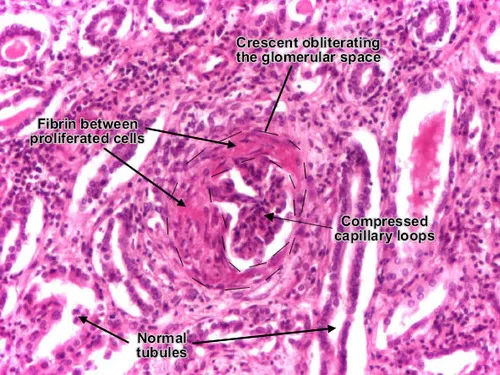 Light micrograph of crescentic glomerulonephritis in RPGN