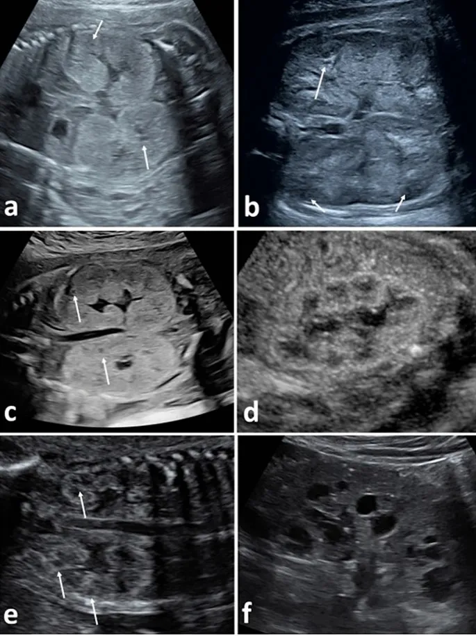 Ultrasound of ARPKD: enlarged echogenic kidneys