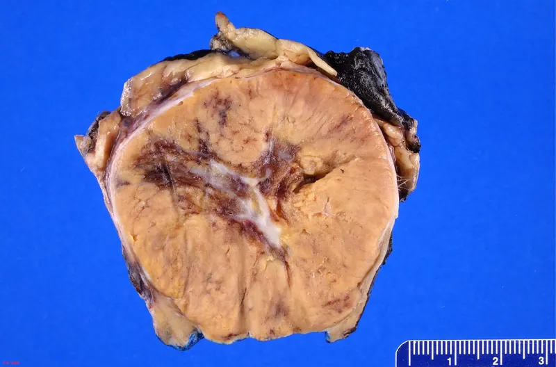 Gross pathology of renal oncocytoma with central scar