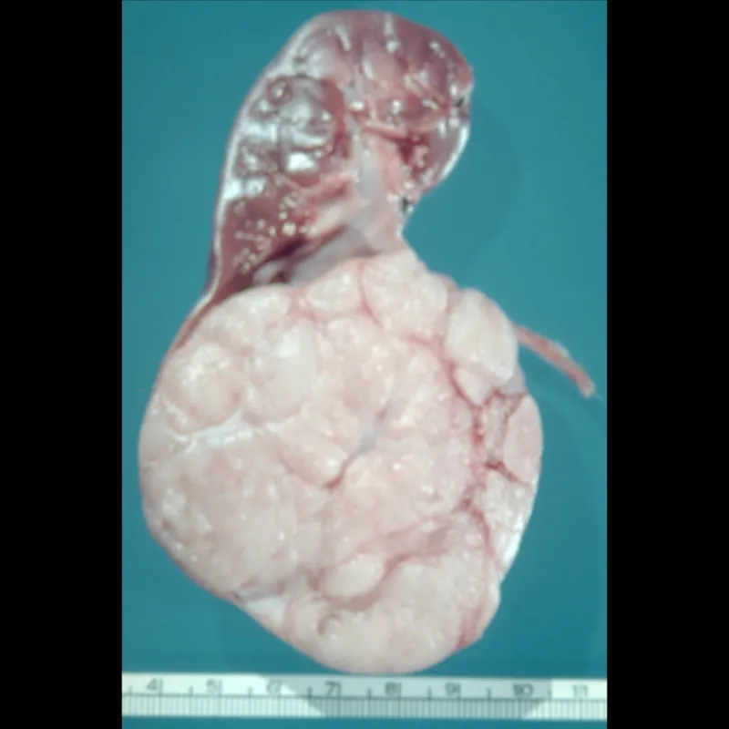 Wilms tumor gross pathology: large unilateral kidney mass